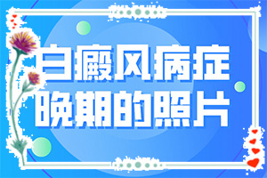 臉上有大面積白斑怎么辦[檢查哪些癥狀]白癩風(fēng)和白斑區(qū)別