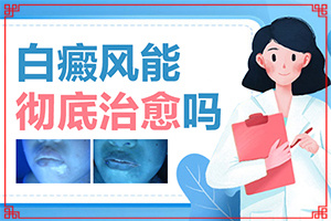 白癩風(fēng)有哪些的癥狀[得了會(huì)有什么癥狀呢]臉上長白殿風(fēng)怎么辦