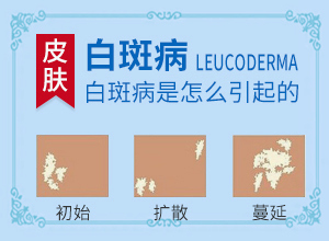 白顛風能治好嗎[治療要注意哪些]兒童白癩風能治好嗎