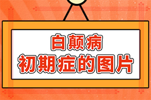 [白癜風(fēng)容易治療嗎小孩白點(diǎn)癲風(fēng)可以治好嗎