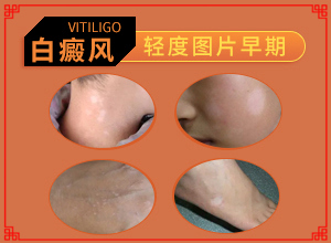 治療白癲瘋醫(yī)院,科學正確治療方法(應該如何)