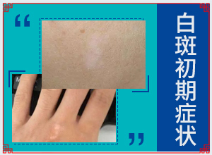 白點癲風(fēng)長什么樣子,如何診斷正確的呢(如何辨別)