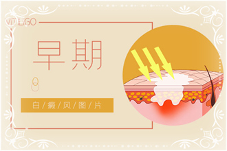 白點風(fēng)病情發(fā)作后白斑癥狀，你了解了嗎