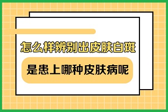 白癩風(fēng)患者運(yùn)動(dòng)改善體質(zhì)，同時(shí)這些事項(xiàng)注意不能缺少