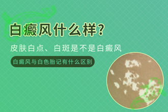 頸部白癩風(fēng)發(fā)作的因素，原來是生活中容易忽視的細(xì)節(jié)