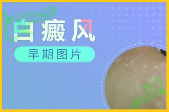 小孩子身上白斑是不是白癩風癥狀初期