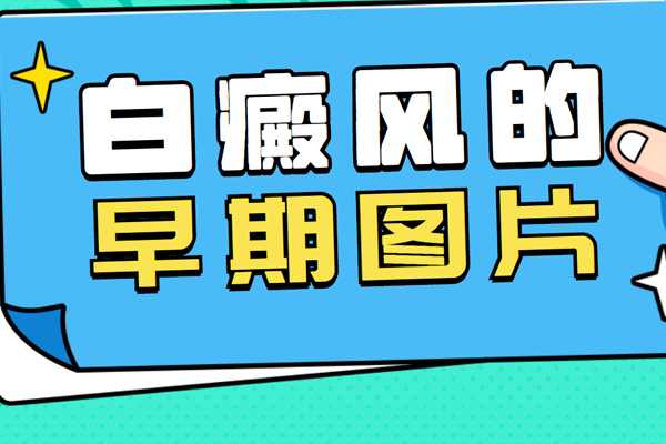 白癩風(fēng)(白斑)的初期圖片-白斑都是白癜風(fēng)嗎?白癜風(fēng)的癥狀表現(xiàn)都有哪些?