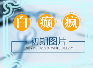 面上出現(xiàn)白班怎么回事,怎么診斷鑒別(都會(huì)有哪些癥狀)