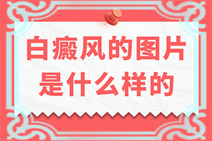 只有手上長白怎么治[治療需要注意什么]新治療白癲的方法