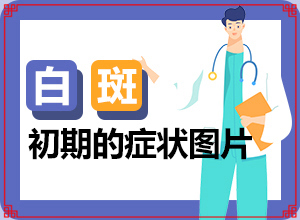 [好方法是什么]在治療白癲最好的辦法