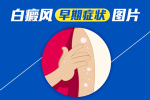 [速度看]早期白癜風的癥狀是什么樣子的-我們可以通過什么判斷識別早期的白癜風