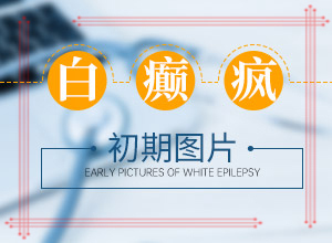 白癩風(fēng)患者能不能[才能更好治療]腰部的白殿風(fēng)好治療嗎?