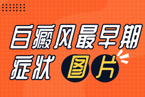[速度看]早期白癜風的癥狀是什么樣子的-我們可以通過什么判斷識別早期的白癜風