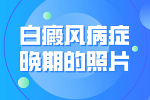 [觀察聚焦]白癜風(fēng)發(fā)展到了晚期會(huì)是什么表現(xiàn)-如何判斷白癜風(fēng)發(fā)展到了晚期
