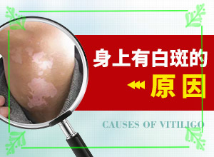 為什么臉上出現(xiàn)一塊白斑,白斑誘發(fā)什么有關(guān)(發(fā)作原因是哪些)