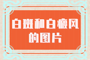 小腿長白班是什么原因[怎樣判斷癥狀]白殿風(fēng)初期癥狀和圖片
