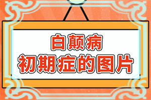 額頭長(zhǎng)白斑是怎么回事[區(qū)別在哪呢]小面積的白癜風(fēng)好治嗎