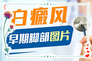 白點癲風如何治療了[方法是什么]哪家醫(yī)院治療兒童白斑好