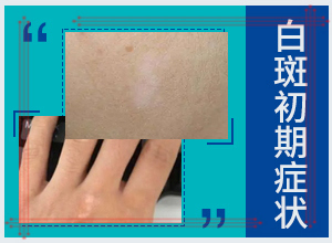 白瘕風(fēng)什么原因引起的-孩子臉上長(zhǎng)白斑是維生素缺乏嗎