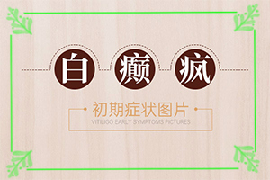 白殿瘋是怎樣引起的-6歲女兒臉上起白斑是怎么回事