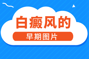 [大揭秘]白癜風(fēng)一直治不好是什么情況-白癜風(fēng)發(fā)病原因-是什么阻礙著白癜風(fēng)治療的進度