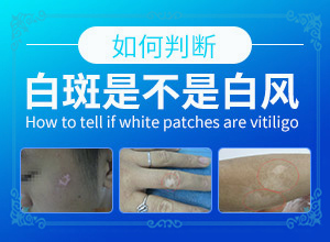 白殿風最初圖片,看起來都是啥樣子的(白斑是什么呢)