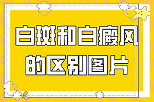 白癲風(fēng)怎么治[如何更好地治療]青少年白斑病到哪里治療