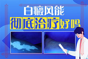 嘴角有一塊白斑一年了還沒(méi)好怎么辦（需要什么樣的治療）