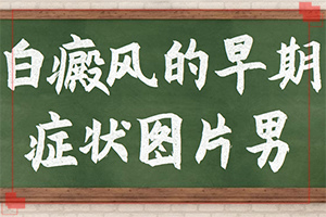 白癲瘋的癥狀圖片,發(fā)病后有哪些癥狀呢(都有哪些表現(xiàn)癥狀呢)