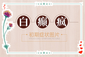 白癲瘋怎么治療好？[怎么治療比較好]兒童白癩癜風(fēng)能嗎