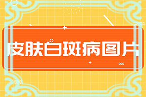 白癩風(fēng)的癥狀圖片-皮膚上有凹陷的白斑圖片