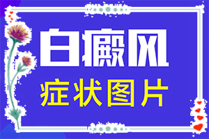 眼角出現白斑-白點癲風有什么癥狀圖