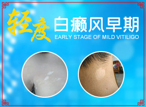 女人身上有白癜風咋辦,不同時期是什么癥狀(初期有哪些癥狀)