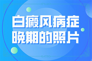 手上發(fā)癢一抓就起白色的-兩歲寶寶臉上長白斑是什么原因