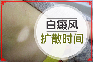 輕度輕度白癩風(fēng)圖片[表現(xiàn)癥狀是啥]皮膚有點白班什么情況