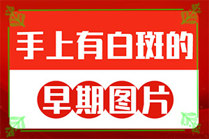 白殿斑早期圖片[不同時期的癥狀]女人身上有白癜風咋辦
