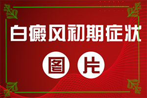 白殿瘋癥狀初期圖片[前期癥狀怎樣]臉上長白班是什么情況