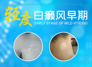 外傷引起瞳孔白斑能治療好嗎。,常見(jiàn)誘因有哪些(發(fā)生因素有哪些)
