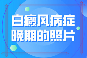 輕微白癩風(fēng)圖片[發(fā)生時有什么癥狀]初期白癲的癥狀是什么